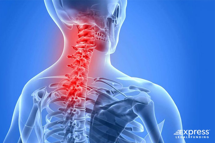 Cervical Fusion Diagram