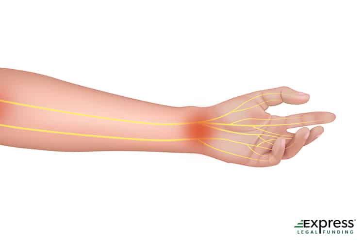 Nerves in an Arm infographic