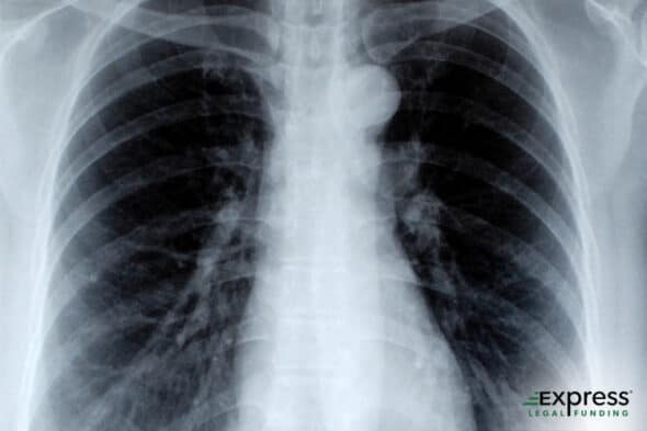 Rib Fracture Accident: Treatment, Recovery, and Legal Recourse
